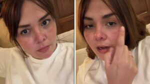 Yuridia pide ayuda tras sufrir una reacci&oacute;n que le quem&oacute; el rostro
