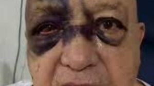 Luis de Alba “El Pirruris” preocupa tras aparecer con lesiones en el rostro, pero confirma que está fuera de peligro