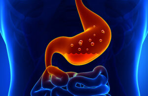 Gastritis