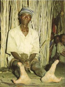 "Pies de avestruz", la extra&ntilde;a malformaci&oacute;n con la que vive una tribu africana