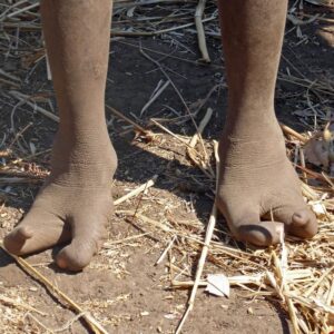 "Pies de avestruz", la extra&ntilde;a malformaci&oacute;n con la que vive una tribu africana