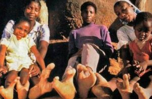 “Pies de avestruz”, la extraña malformación con la que vive una tribu africana