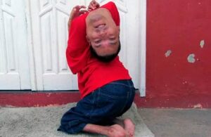 Claudio, el hombre que naci&oacute; con la cabeza al rev&eacute;s dio positivo a Covid