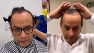Germ&aacute;n Ortega se injert&oacute; cabello y dice sentirse &iexcl;de pelos!