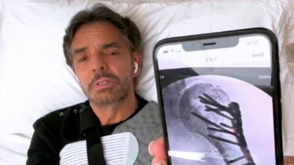 Eugenio Derbez y la dolorosa rehabilitaci&oacute;n que enfrenta