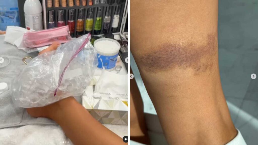 Thal&iacute;a sufre aparatoso accidente y muestra los moretones que le quedaron