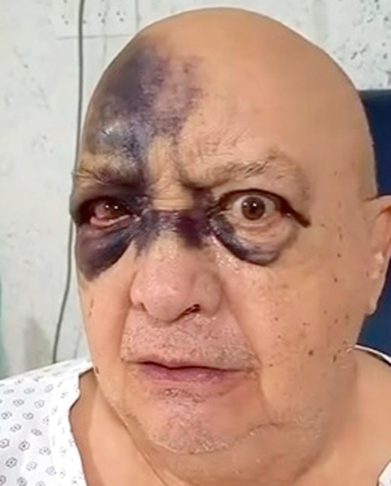 Luis de Alba muestra su recuperaci&oacute;n tras el fuerte golpe en el rostro y revela c&oacute;mo cambi&oacute; su vida despu&eacute;s del accidente
